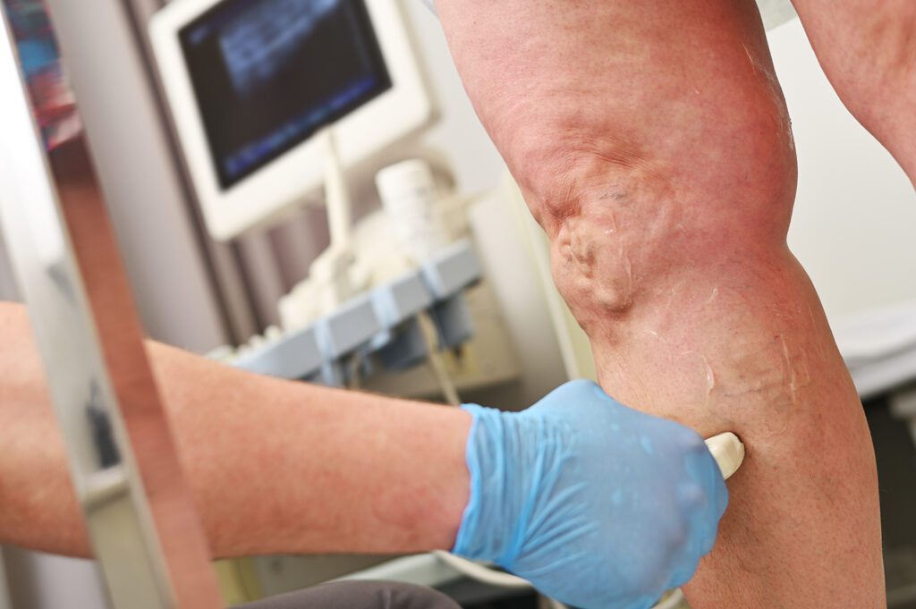 Endovenöz trunkal ablasyon tedavisi